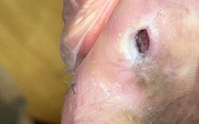 高齡糖尿病患者搭配使用「自體血小板裂解液」幫助傷口癒合