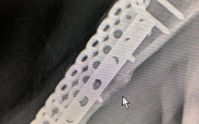 搭配「自體血小板裂解液」使用促進骨癒合